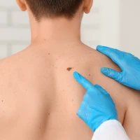 Можно ли в домашних условиях удалить родинку?